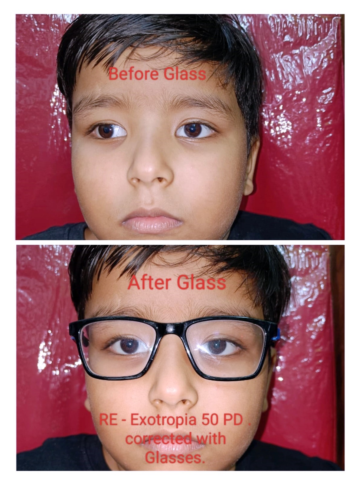eotropia_50_pd_corrected_with_glasses.jpeg