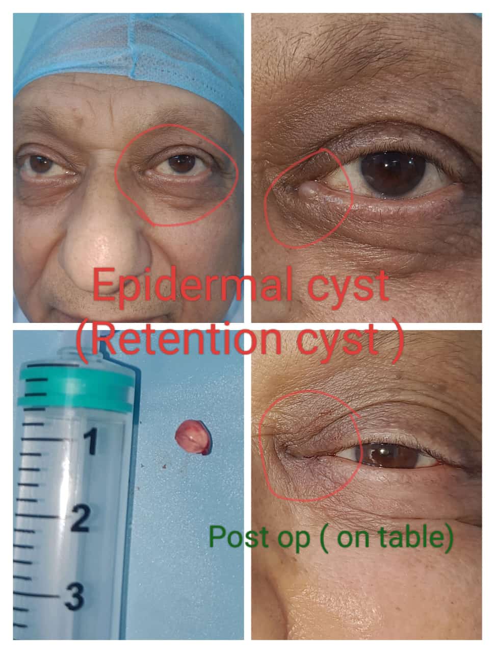 epidermal_cyst.jpeg