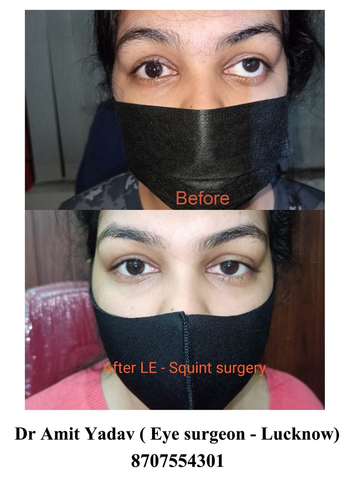 le_squint_surgery_1.jpeg